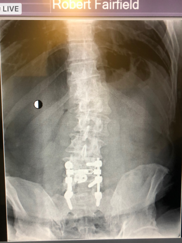 Rob-Fairfield3-spine-xray-770×1024